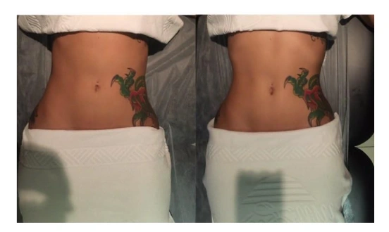 Fotografias reais do abdômen de uma cliente, antes e depois do atendimento